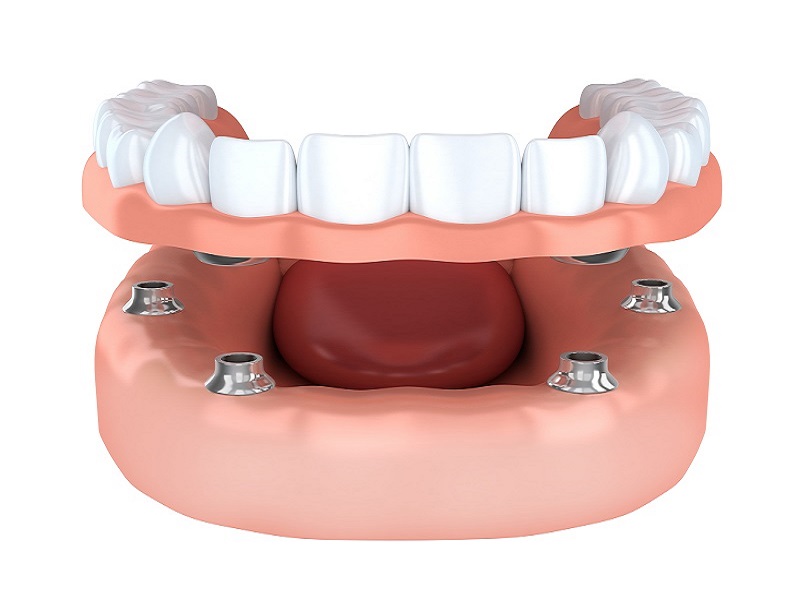 Why Are Dental Implants Better Than Dentures and Dental Bridges?