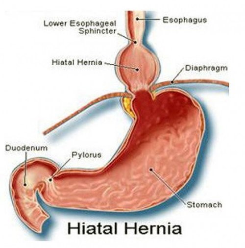 8 Types of Hernia - Symptoms in both men and women and treatments