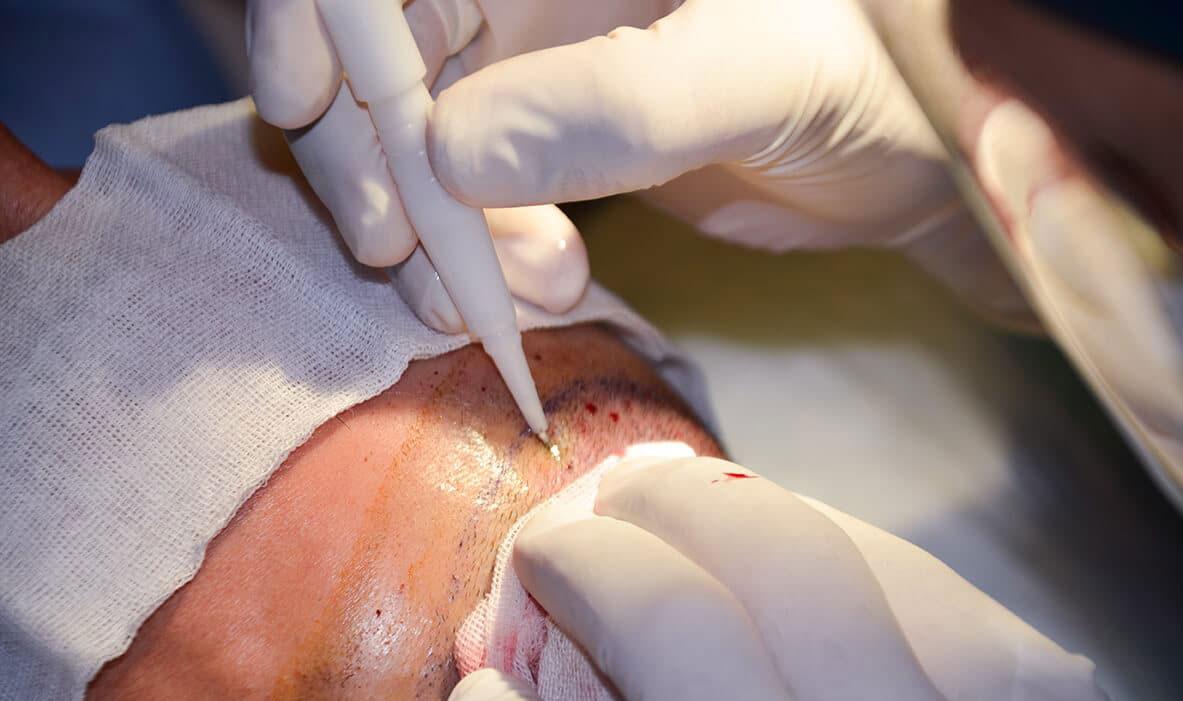 How the ‘Aesthetic Hair Implants - AHI’ Transplant Technique has made Transplantation Treatment Better