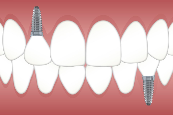 Are Dental Implants For Everyone?