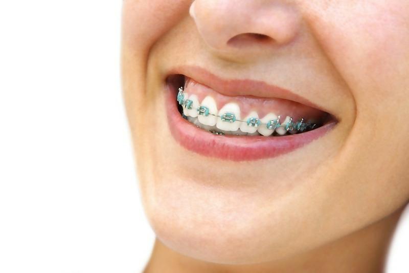 How Does the Invisalign Treatment Process Work