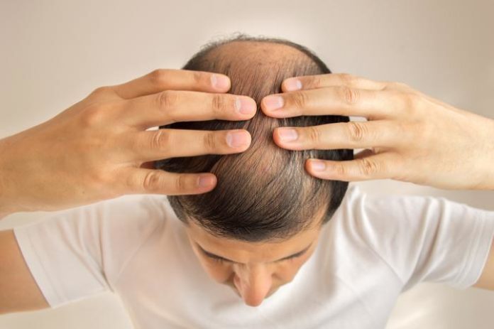 minoxidil hair loss treatment