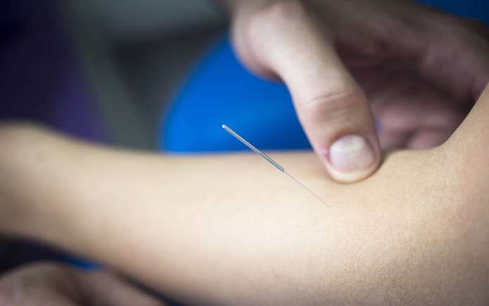 Acupuncture for your Body