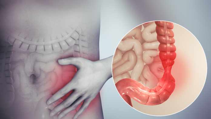 main causes of Irritable Bowel Syndrome