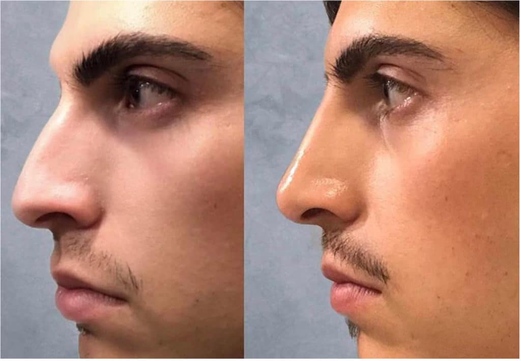 The Liquid Nose Job: Can You Reshape Your Nose Without Surgery? 