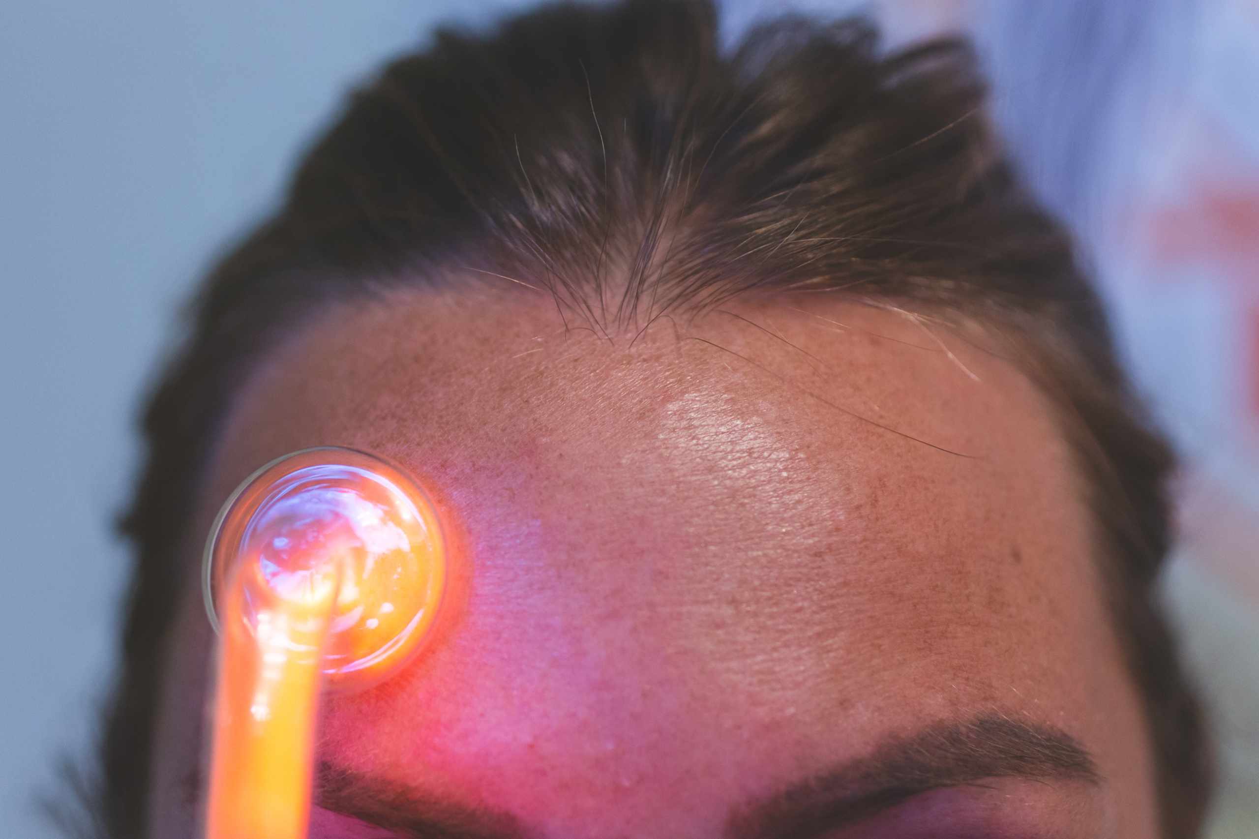 Should You DIY Acne Treatments? A Short Guide