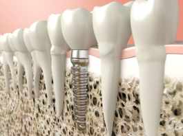 a Dental Implant