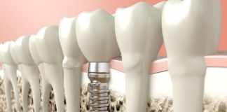 a Dental Implant