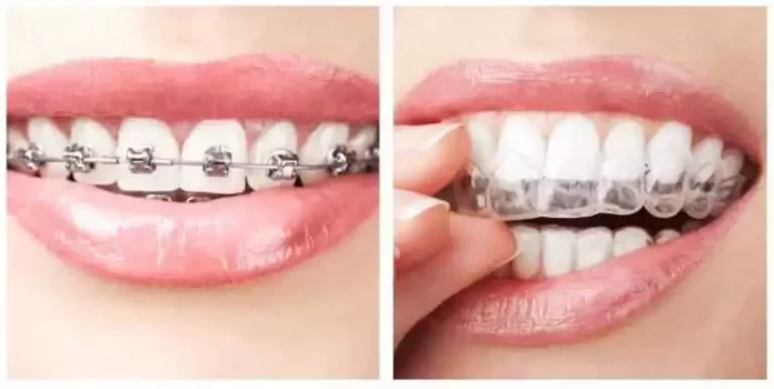 Clear Aligners over Conventional Braces