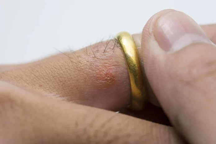 Is Your Wedding Ring Making You Sick? Here's What You Need to Know