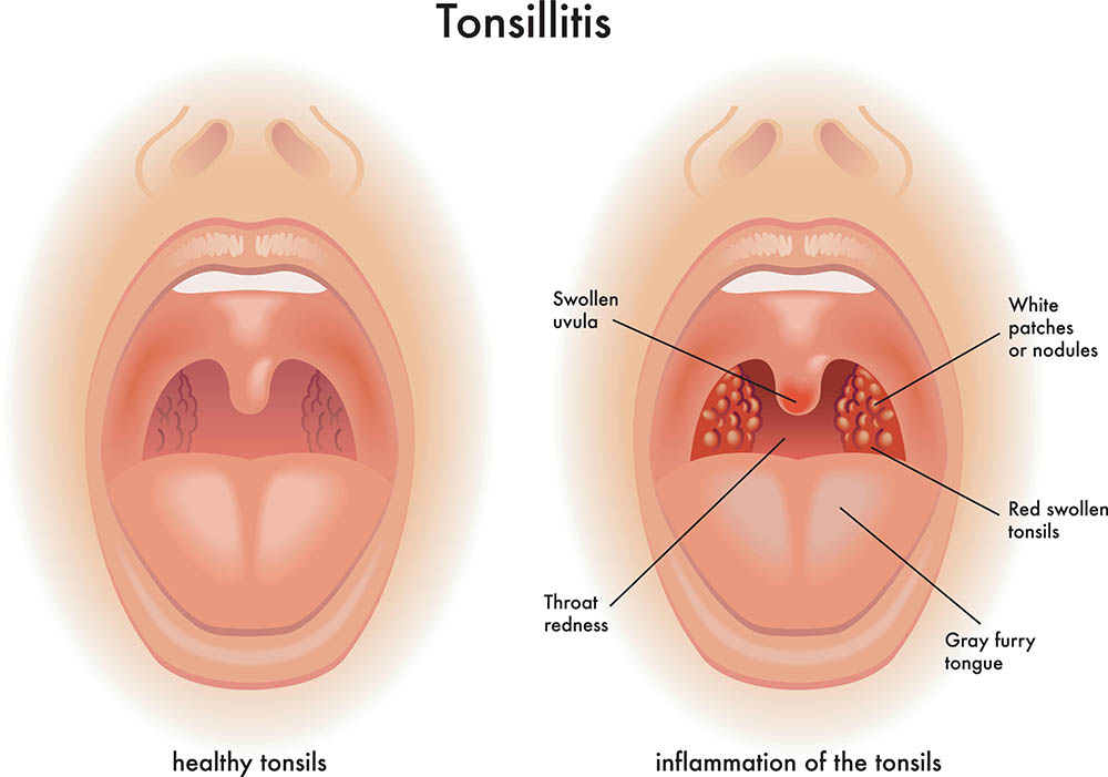 The causative agents of white spots on tonsils
