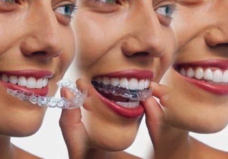 Invisalign is an expensive method