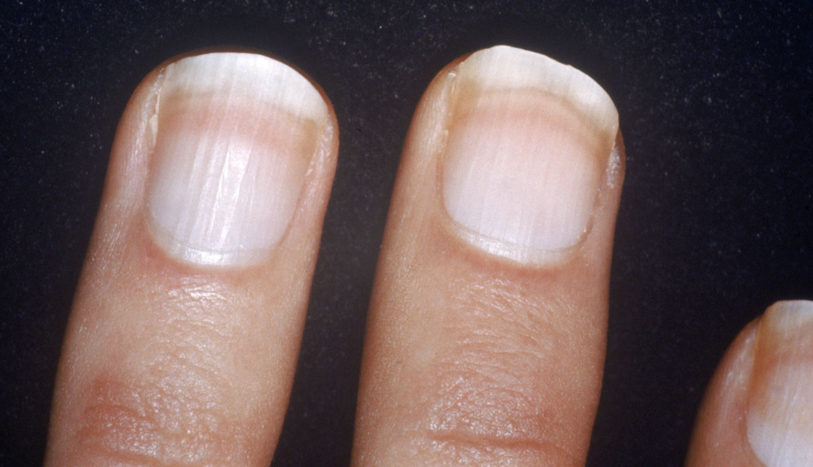 Milky nails indicate an underlying medical condition