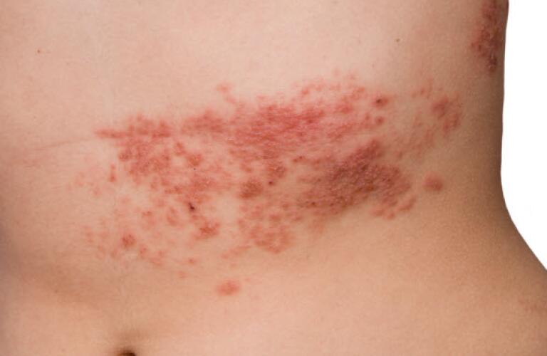 Which complications are associated with the rash on the stomach?