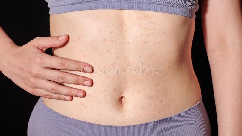 How to get rid of the rash on the stomach?