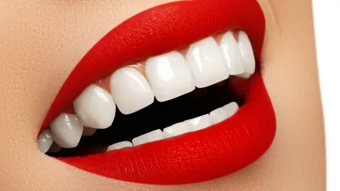 Dental Veneers