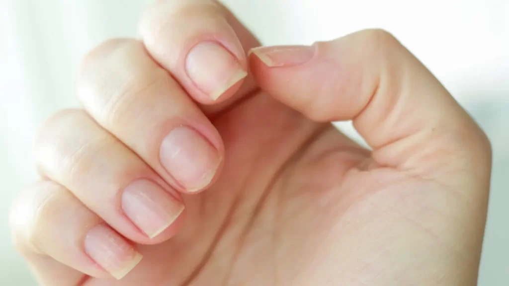 Identifying the Causes of Yellow Nails
