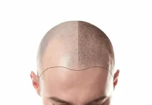 Hair Transplant Abroad: Choosing Safety Over Hype